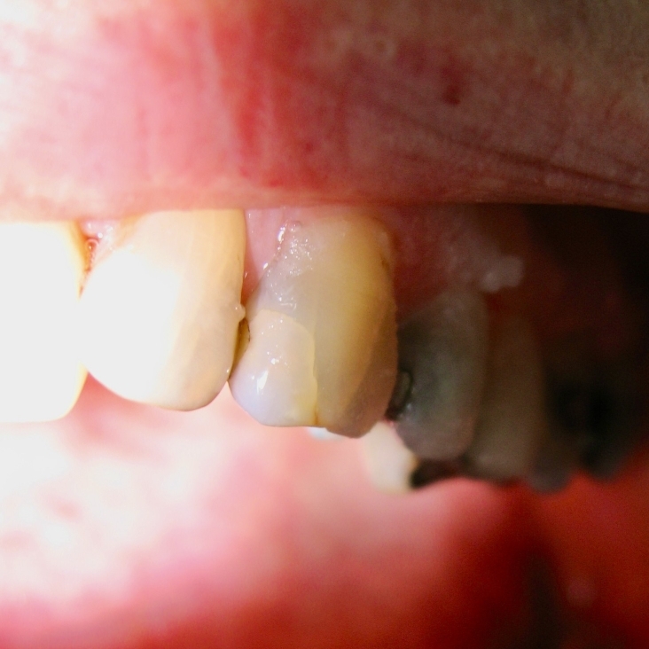 alt="fracture tooth TLC dentists Richmond NSW"