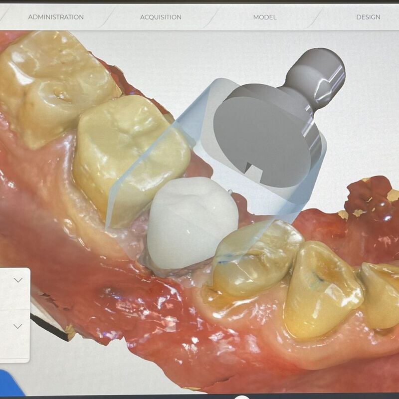 alt="digital dentistry 3D scan same day crowns invisalign Richmond NSW"
