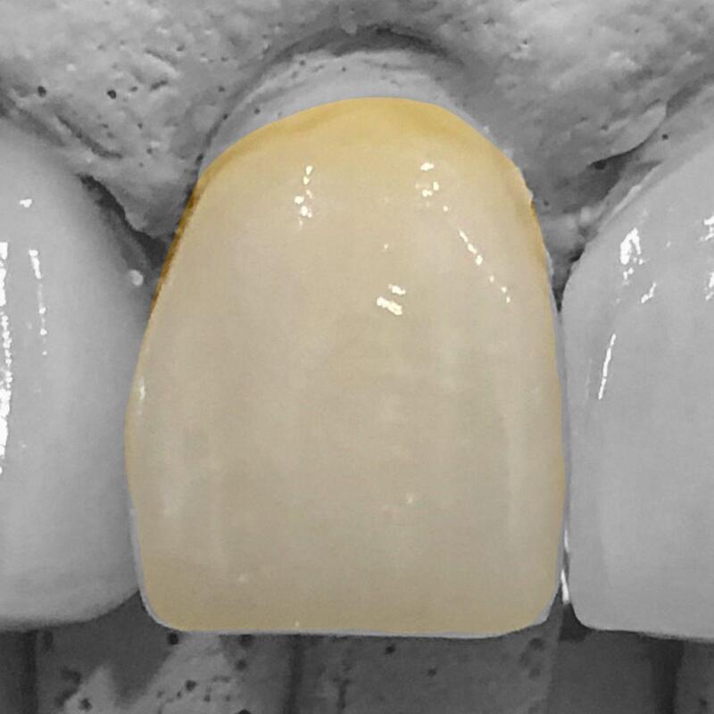 alt="digital dentistry 3D scan same day crowns invisalign Richmond NSW"